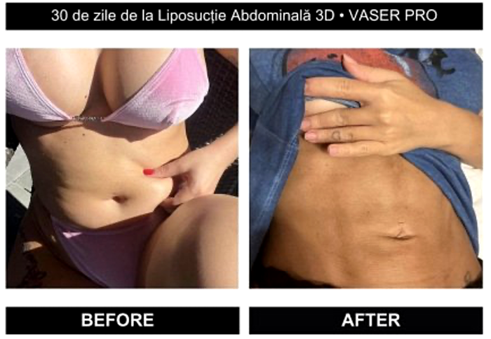 before & after Liposucție VASER PRO 4K