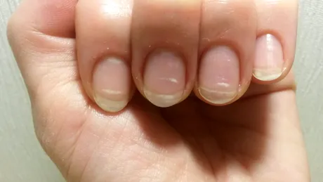 Ce sunt petele albe de pe unghii și din ce cauze apar?