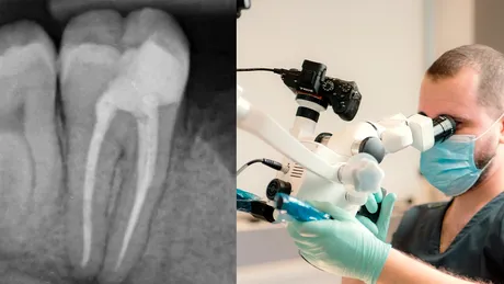 (P) Durerea de masea si tratamentul de canal: cand poate fi util microscopul dentar