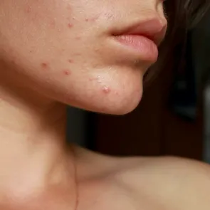 Alimente pe care să le eviți dacă iei acest tratament pentru acnee. Riști complicații severe