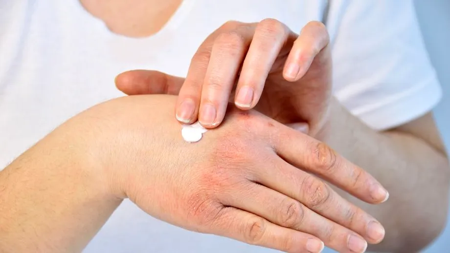 Cum ne protejăm pielea de ger. Detaliază medicul dermatolog Oana Spânu
