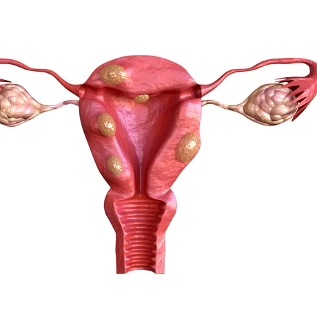 Fibrom uterin – 7 semne și simptome supărătoare