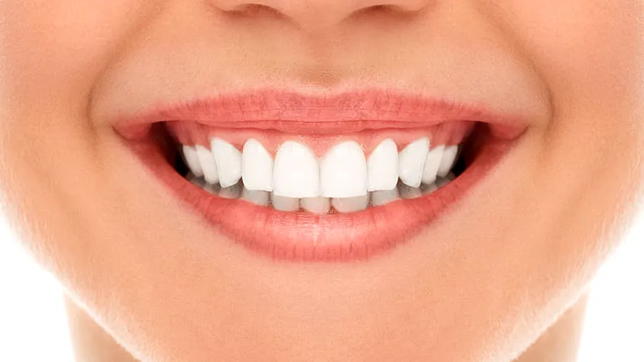 Albirea dentară: 5 lucruri pe care trebuie să le ştii înainte de tratament