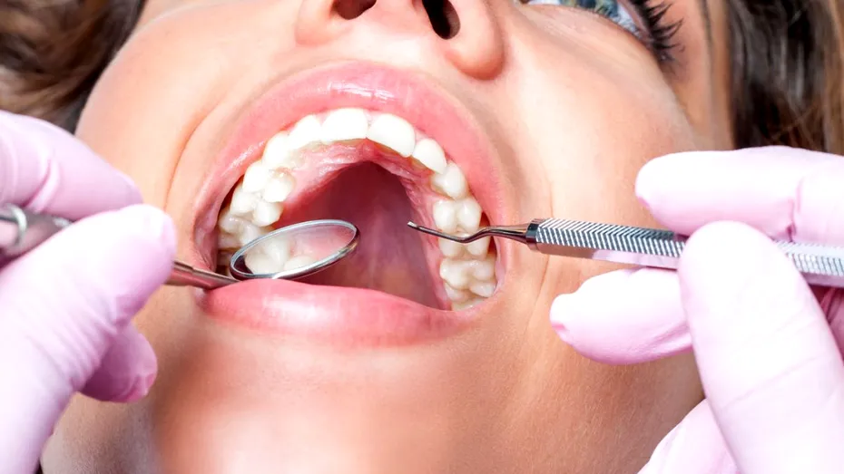 Problemele dentare: la ce riscuri te supun în afară de carii