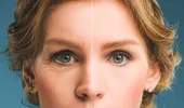 Mit sau adevăr în estetica facială – despre acidul hialuronic