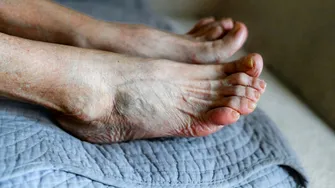 Picioarele crăpate îți pot pune viața în pericol! Află ce semn ascund acestea despre sănătatea ta
