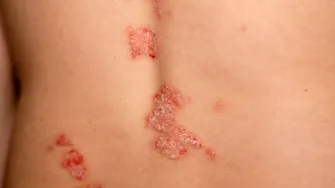 Remedii naturale care pot ajuta în psoriazis. Ce metode au fost studiate și ce trebuie evitat?