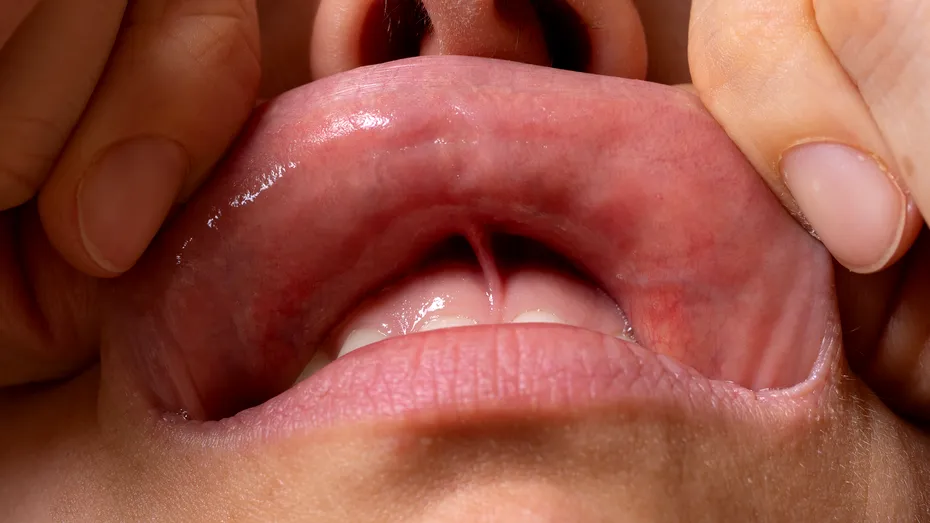 Semnul care apare pe buză la bătrânețe și crește riscul de demență. La ce să fii atent