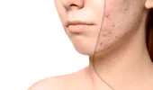De ce apar petele pigmentare mai repede vara. Remedii naturale care uniformizează tenul