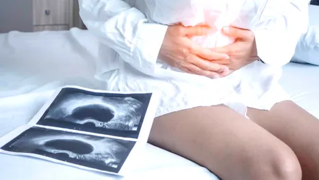 Chisturile ovariene: fals și adevărat despre această afecțiune ginecologică des întâlnită