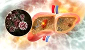 O dietă populară, vinovată pentru cancerul hepatic. Accelerează apariția lui prin „reprogramarea” celulelor hepatice