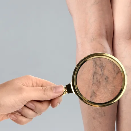 Scapă de varice fără medicamente. Rețeta naturistă care îți salvează picioarele