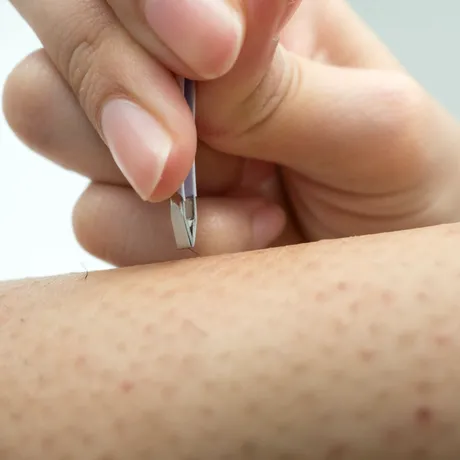 Tot ce trebuie să știi despre firele de păr crescute sub piele