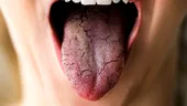 1 din 5 români suferă de senzația de gură uscată