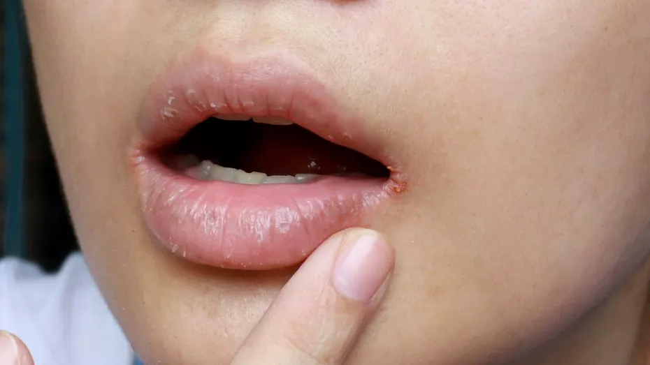 Semnul de pe buză care indică o boală de inimă în care sângele „circulă invers”