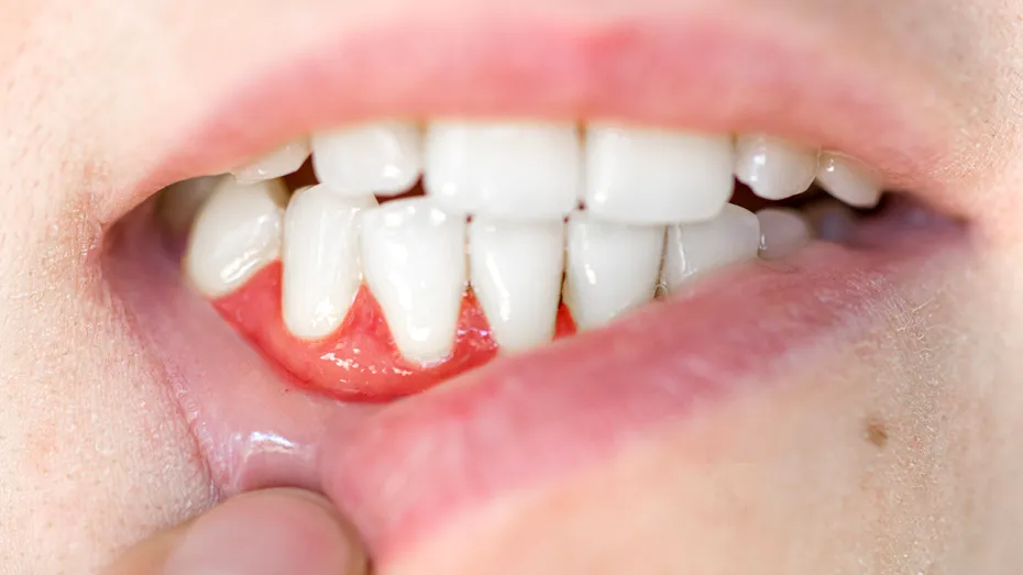 5 semne că ai oasele fragile și risc mare de osteoporoză. Indiciul pe care îl vezi în gură