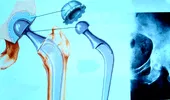 Fractura de şold la persoanele cu osteoporoză duce la deces în 20% din cazuri