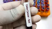 Testul de sânge gratuit care ajută la descoperirea cancerului de colon în stadiu incipient