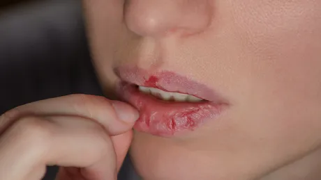 Dermatillomania – când pielea devine ținta unei lupte interioare