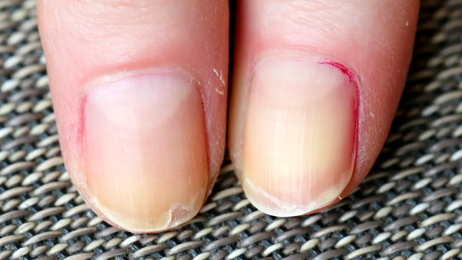 Semnele de pe unghii când ai probleme cu ficatul