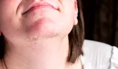 Bolile care duc la apariția firelor de păr în barbă la femei, mai ales la cele supraponderale