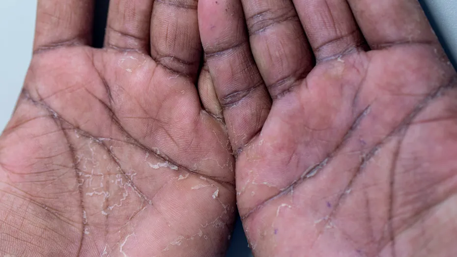 „Ridarea excesivă” de pe mâinile unui tânăr s-a dovedit a fi o afecțiune rară