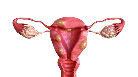 Fibrom uterin – 7 semne și simptome supărătoare