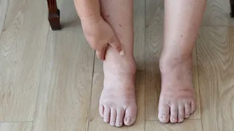 Ai mâini și picioare umflate vara? Boala care stă în spatele acestui simptom