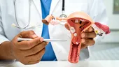 Cancerul ovarian: ce este, cât de frecvent este în România, teste care-l depistează, tratament