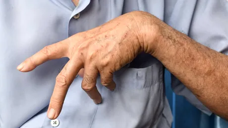 Spasticitatea, una dintre cele mai frecvente complicații după AVC