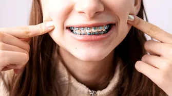 Forța de frecare în aparatele ortodontice: ce înseamnă, de ce contează și ce ar trebui să știe pacienții