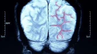 7 semne „tăcute” de alarmă care pot indica faptul că trebuie să faci angiografie cerebrală