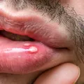 Cum scapi mai repede de afte. Remediile naturale care calmează durerea și grăbesc vindecarea