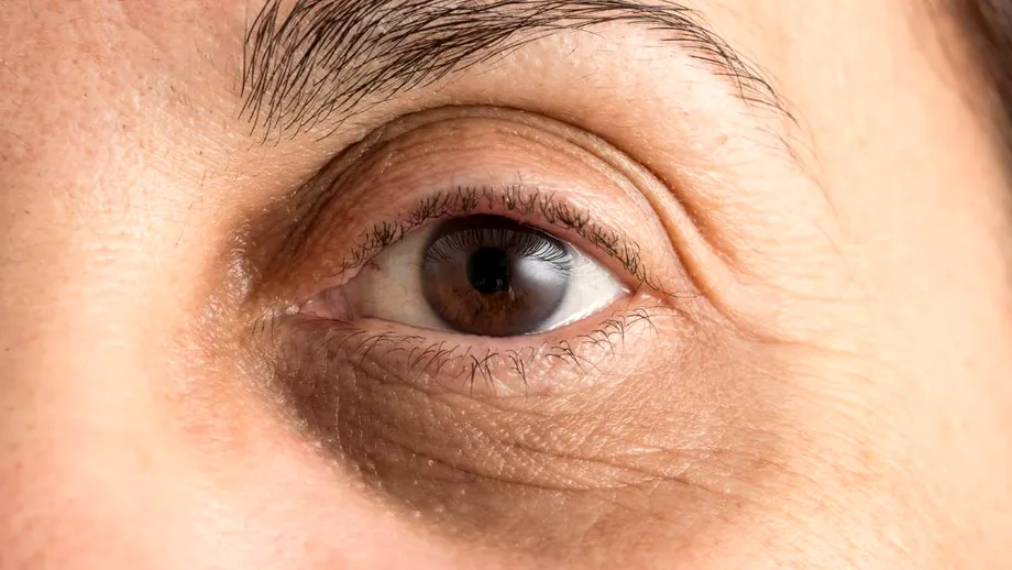 Cum să tratezi cearcănele, dacă sunt vineții, maro sau gri