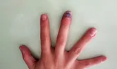 Semnul „tăcut” de pe unghii care îți arată dacă ai cancer
