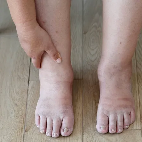 Ai mâini și picioare umflate vara? Boala care stă în spatele acestui simptom