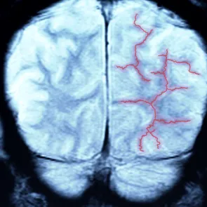 7 semne „tăcute” de alarmă care pot indica faptul că trebuie să faci angiografie cerebrală