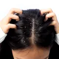 Cum poți scăpa de mătreață în mod natural. Obiceiurile care pot reduce exfolierea scalpului și preveni reapariția ei