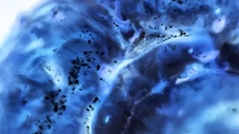 Cancerul pancreatic ar putea fi depistat cu până la 5 ani înainte. Cum ar putea ajuta inteligența artificială