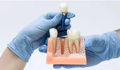 (P) Îngrijirea după implant dentar: reguli simple care pot susține rezultatul pe termen lung