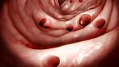 Top 5 cele mai frecvente boli ale colonului și semnele pe care le dau
