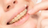 Cât costă un aparat dentar în funcție de materialul folosit