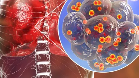 Infecţia stafilococică: simptome, cauze, tratament