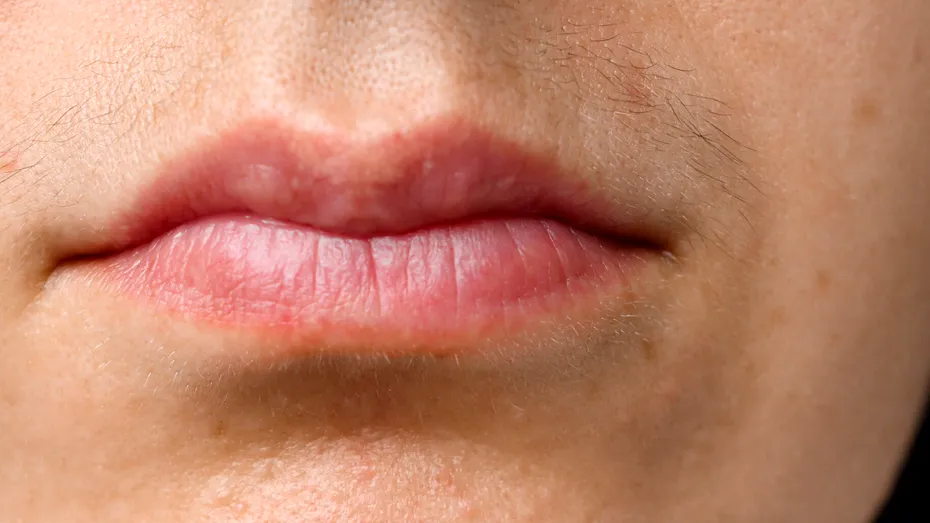 Hirsutism: cauze, simptome, tratrament