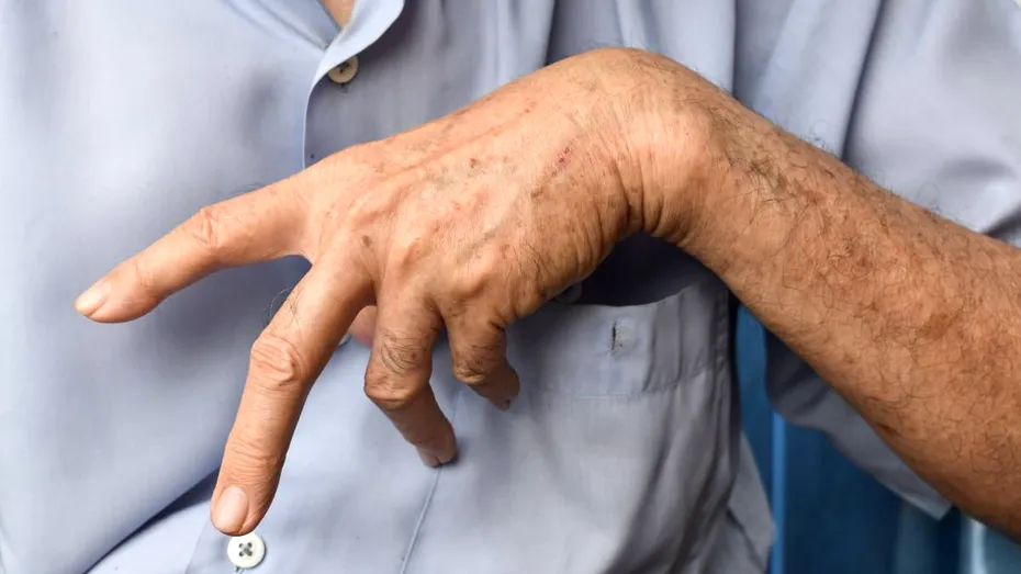 Spasticitatea, una dintre cele mai frecvente complicații după AVC