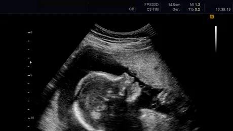 A stat mai bine de 56 de ani cu un făt pietrificat în pântece. Cum a trecut neobservat la analize