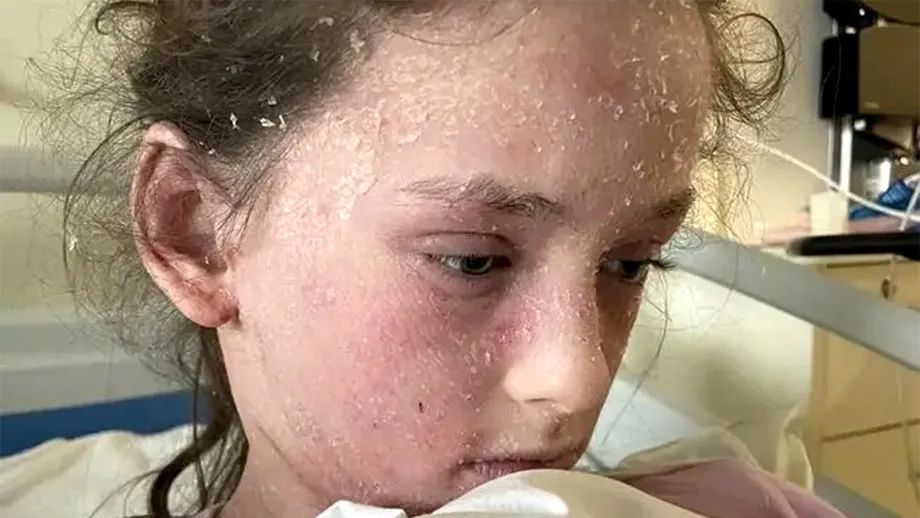 Boala rarisimă cu care a fost diagnosticată această adolescentă. E alergică la propriile lacrimi, dar nu doar atât