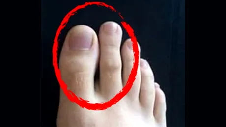 Ai al doilea deget al piciorului mai lung decât degetul mare? Este sau nu o anomalie?