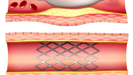 Operaţia de stent la inimă