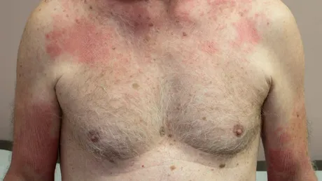 Fotosensibilitate indusă de medicamente: simptome, cauze, tratament